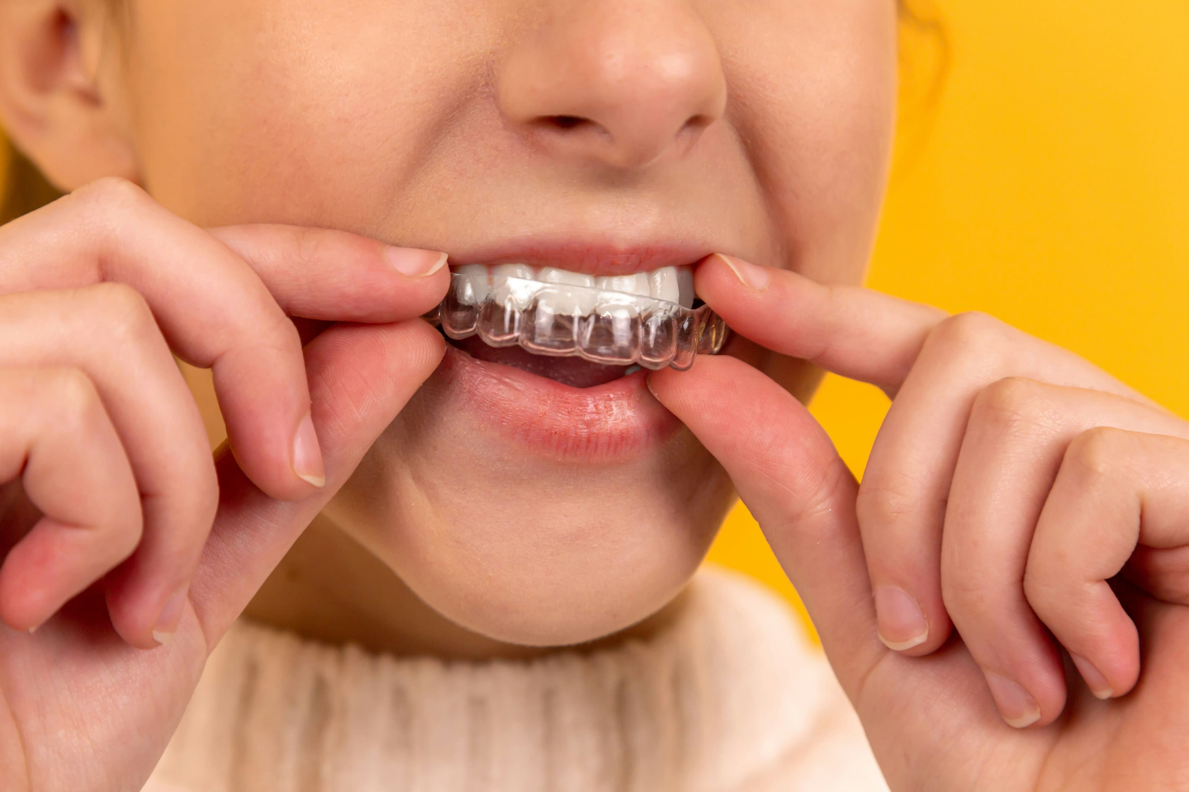 Invisible Aligners