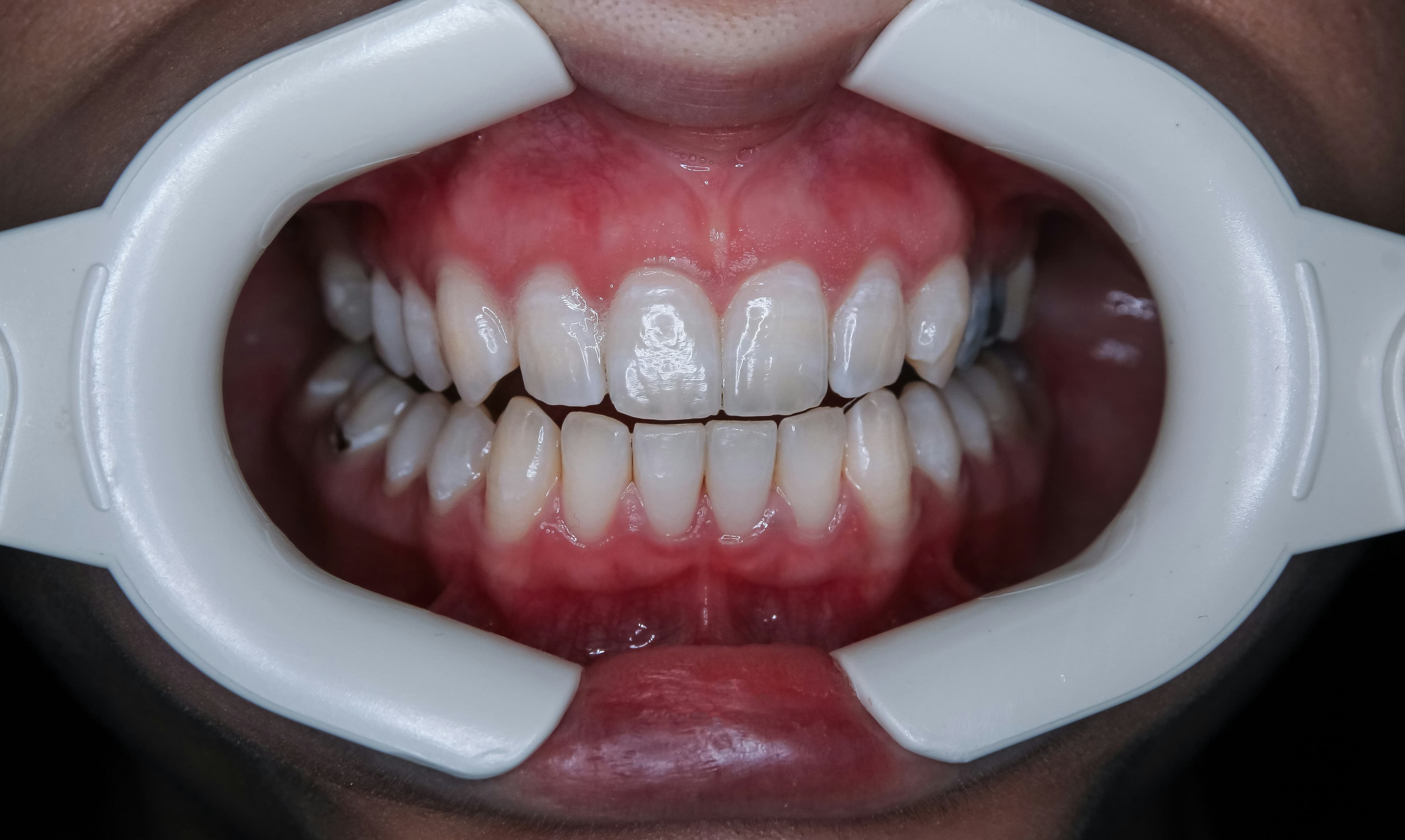 Full Smile Reconstruction